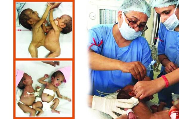 Hindi Stories: कंजौइंड ट्विन्स